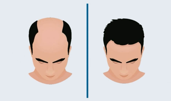 Hair Transplant